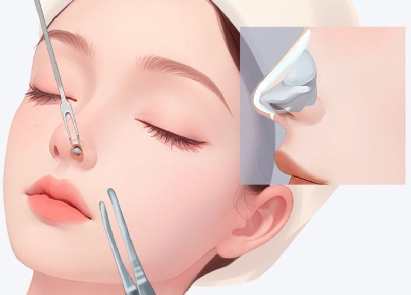 五、关于李超仁隆鼻的常见问题解答（FAQ）