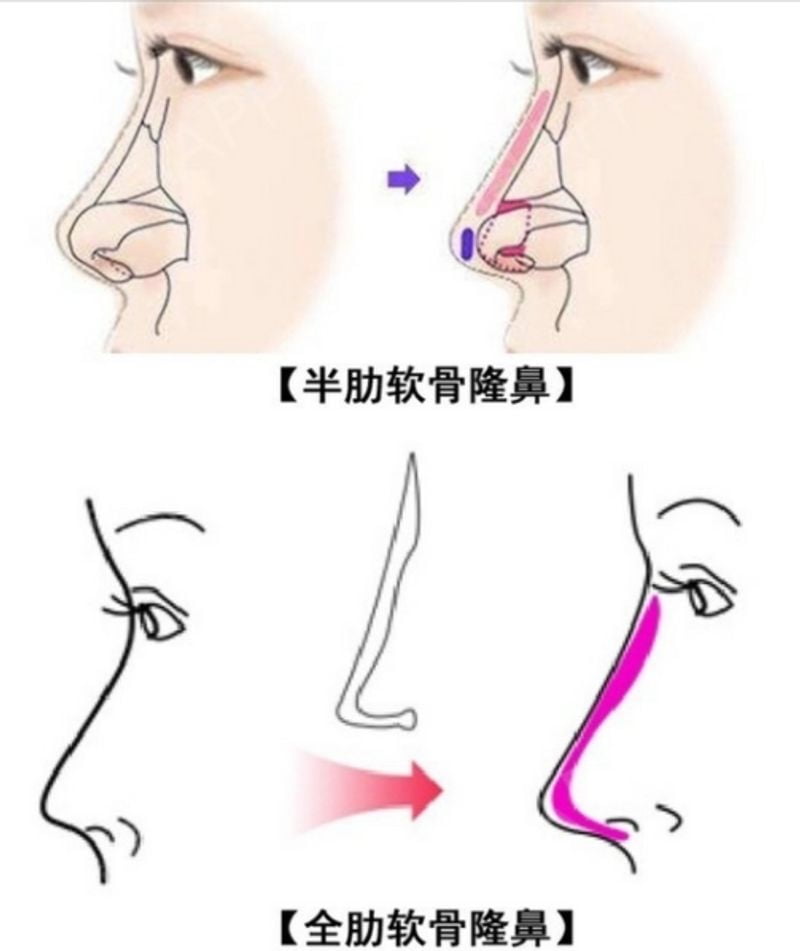 赵士俊医生肋骨鼻成效亮点：鼻尖表现点清晰，海鸥线自然，不顶白不透光