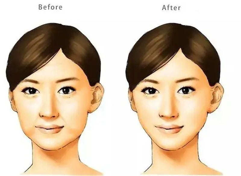 五、不是所有人都适合!汪栋梁中面部提升的边界条件www.aimei.com