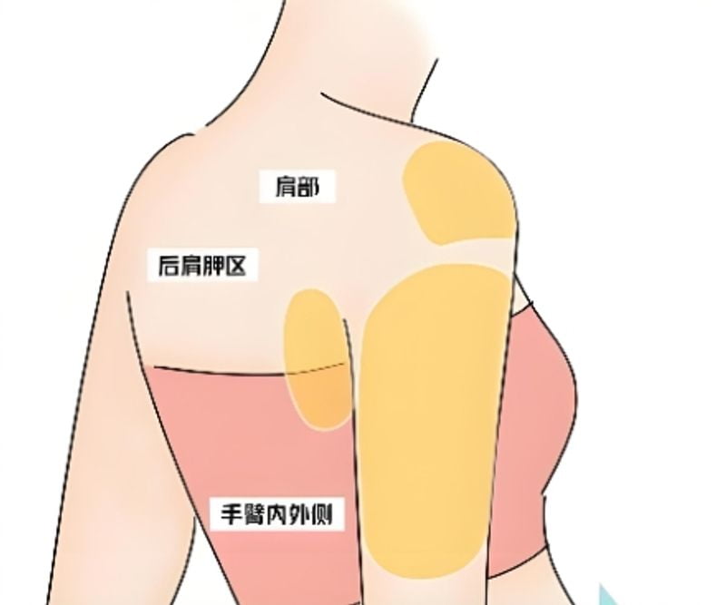 二、除了医生技术,还有哪些因素影响手臂吸脂疗效?