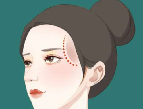 三、太阳穴填充多少钱一次？算清“长期账”才不花冤枉钱