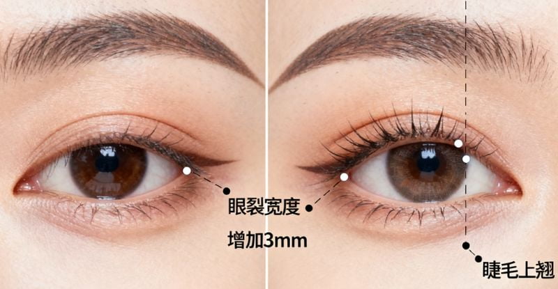 微创双眼皮最低多少钱？县城做埋线2980元起能信吗