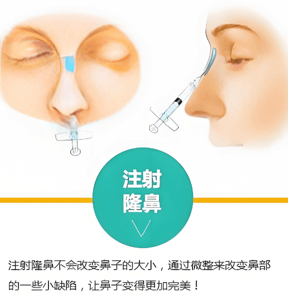 三、肖玮医生注射隆鼻适合你吗?这些事一定要知道