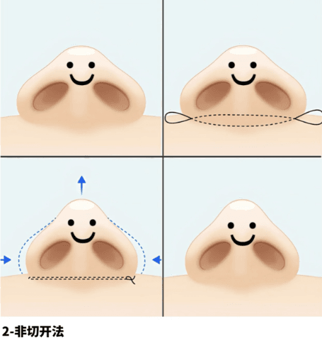 太原隆鼻价格与材料选择全指南