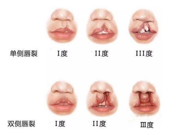 田孝臣做唇裂二期修复怎么样？鼻唇联合修复是他的强项