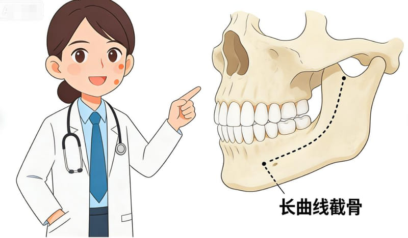 柳超下颌角多少钱?长曲线截骨3.5万起,基础截骨2.8万起