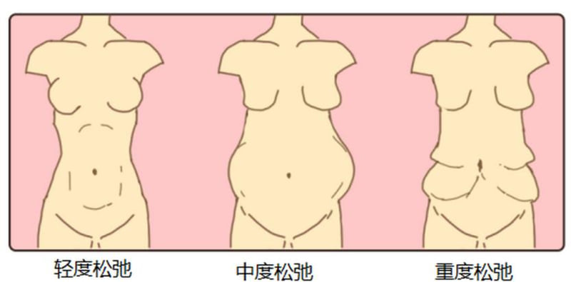 三、任杰做腹壁整形费用构成与透明定价