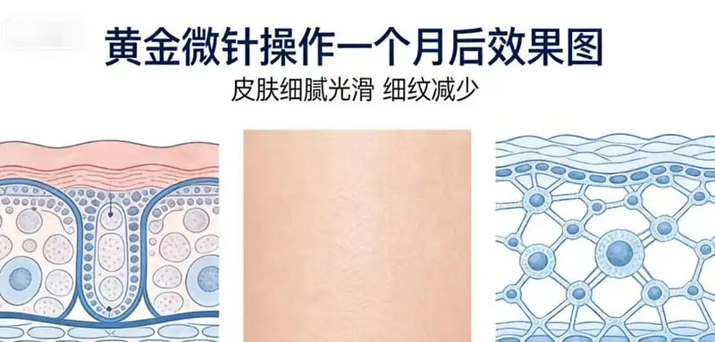岳阳禾美荟医疗美容黄金微针祛痘怎么样？嘞做完出油少哒毛孔也细哒，美卫士上做过的人港的蛮准