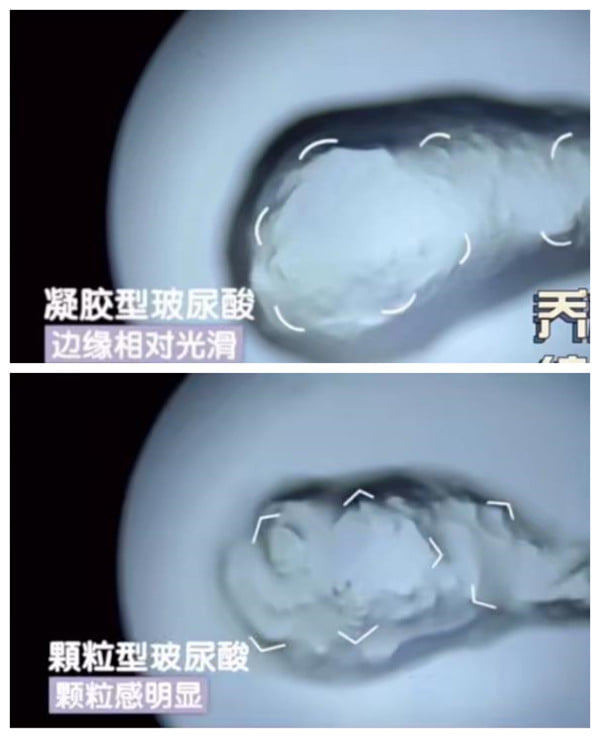 四、关于玻尿酸填充面部,几个常见的决策误区