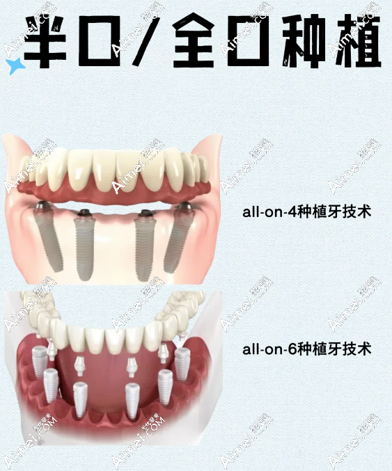 替爸妈跑完交底！广州柏德口腔半口种植牙真的只要2万？去贝色预约还能领免费CT名额！