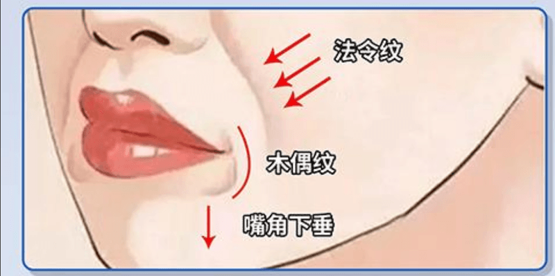 二、口周年轻化改善法令纹常见手段与洛阳维多丽亚技术亮点