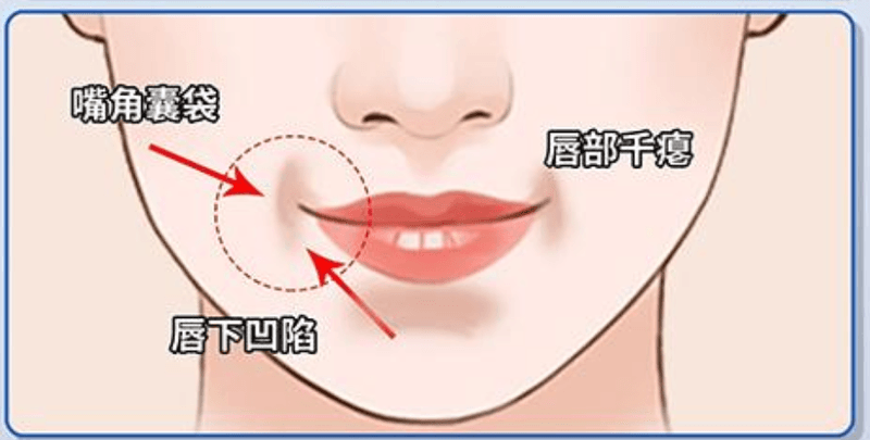 三、去洛阳维多丽亚做法令纹改善的面诊全流程与真实体验