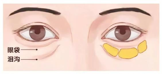 三、焦作缔莱美医生打胶原蛋白泪沟的手法靠谱吗？www.aimei.com
