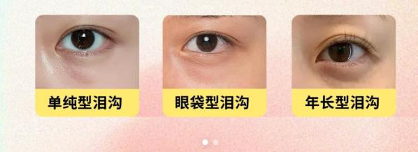 二、打胶原蛋白填泪沟比打玻尿酸好在哪里？