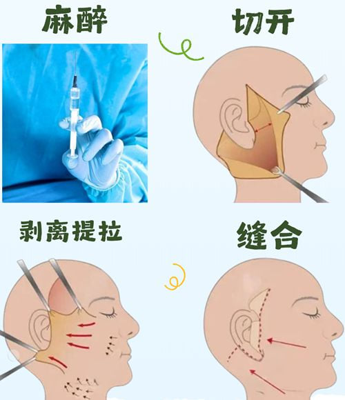 杜太超和黄寅守约谁做拉皮手术好？小切口技术选杜太超，V美减龄选黄寅守