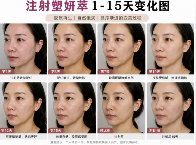 注射塑妍萃1-15天变化图