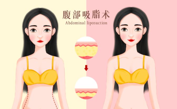 五、金华丽都激光吸脂真实用户常见疑问解答（FAQ）