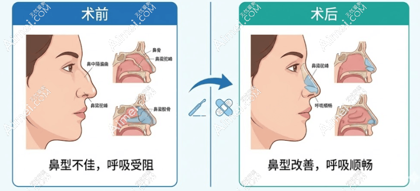 隆鼻