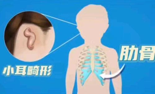 张正文耳再造靠谱吗？微创取肋创伤小，尤其适合年幼患者