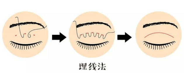 三、2026年长沙协雅双眼皮手术价格与项目明细解读www.aimei.com