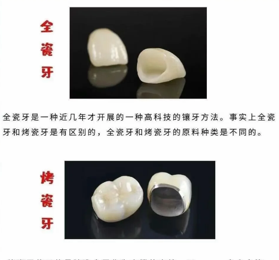 026 北京烤瓷牙价格汇总！钴铬、贵金属牙冠收费参考，上贝色比对多家口腔报价