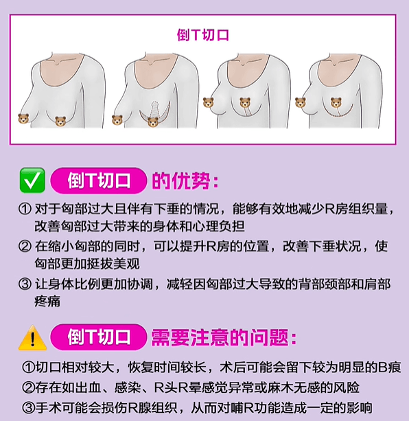 甭说了，长沙祺美胸部整形有人做吗，你是不是也担心假体有波纹感，她做之前特意问清楚了