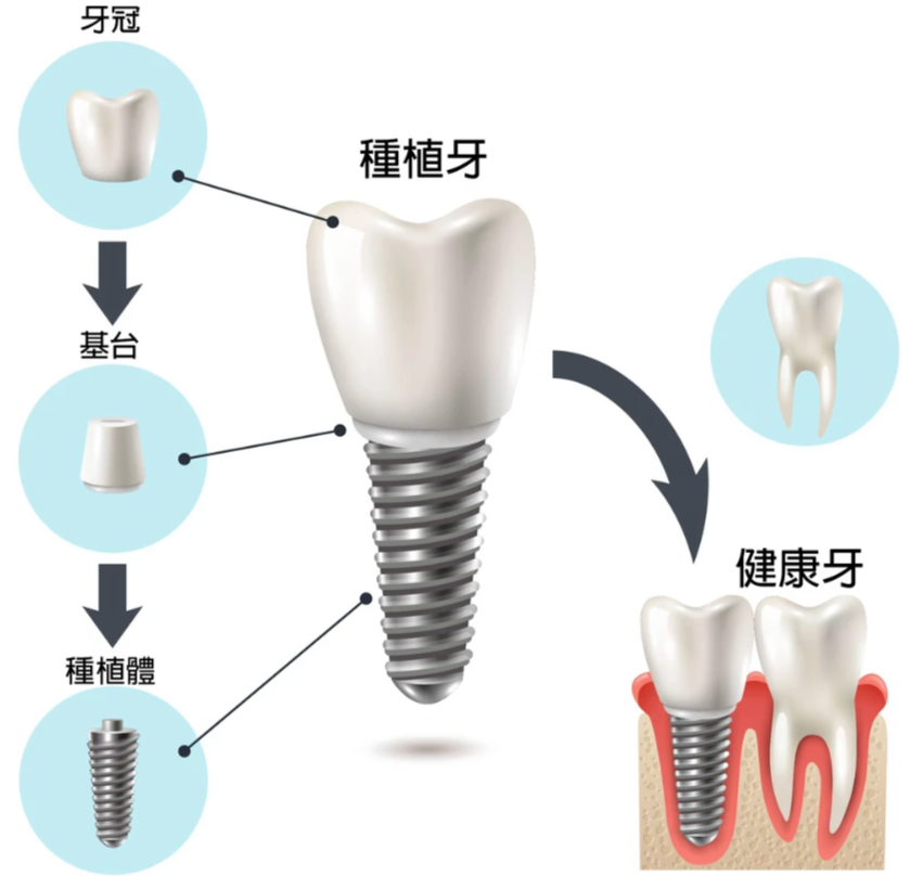 银川诺贝尔口腔种植牙价格一览：2026最新价目表及就诊全攻略（附贝色预约通道）