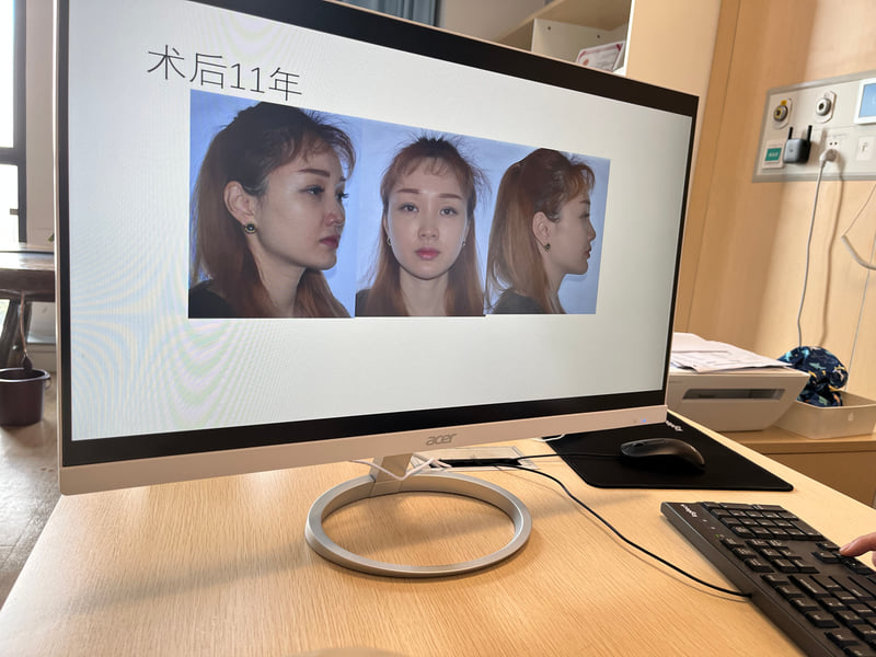 重庆松山轮廓固定多少钱？颧骨内推2.8万起，下颌角3万起，上官文松医生主刀