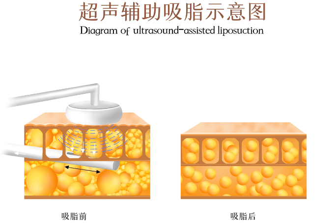 杭州丽脂超模体雕成效：分层精细深抽浅雕，做完直接拥有超模S曲线，还很自然